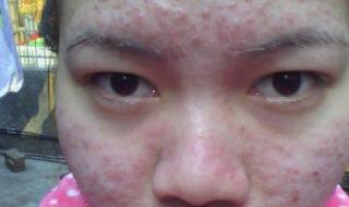 脸上长痘痘了怎么办 脸上长痘痘该怎么办